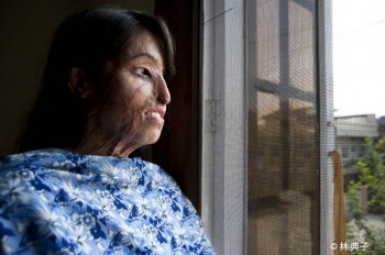 パキスタンの硫酸被害の女性